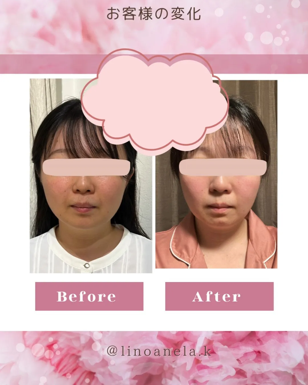 リノアネラの施術は、まず凝り固まった筋肉を丁寧に緩め、柔軟性...